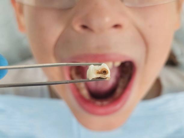 Best Dental Abscess Treatment in Boyd, TX
